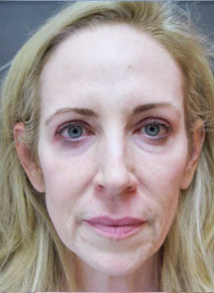 Transformation Picture Before