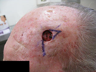 cancer and treatment skin County Cancer Surgery Mohs Skin in Orange & Removal